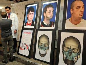 Full face transplant promises less risk of rejection