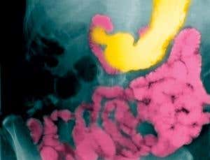 Gut-on-a-chip takes bellyache out of digestion studies