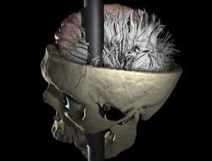 Phineas Gage brain pathways mapped for the first time