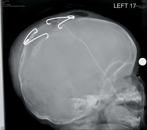Springs will gently push apart the plates of baby Viggo's skull 