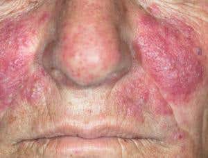 Rosacea may be caused by mite faeces in your pores