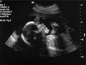 Fetal healing: Curing congenital diseases in the womb