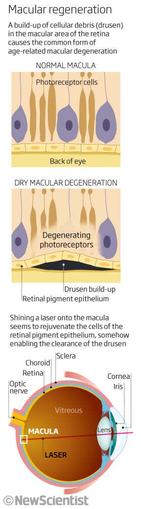 Macular regeneration
