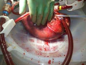 Donor livers kept alive outside the body for 24 hours