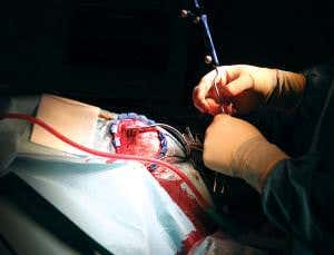 How a surgeon installs seizure sensors inside a skull