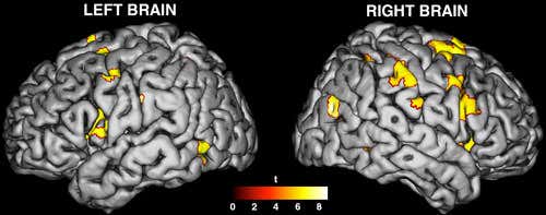 Brain activity associated with sensations from the phantom hand