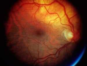 Stem-cell treatment restores sight to blind man