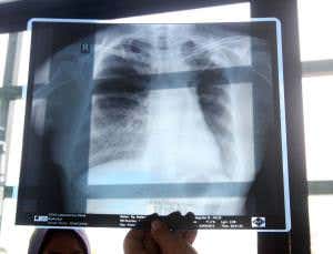 Ethnic background influences immune response to TB