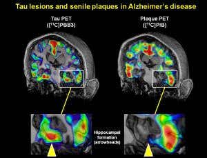 New imaging shows Alzheimer's unfolding in live brains