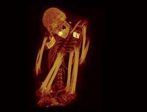 Ancient afflictions: Mummies got heart disease too