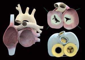 Replacement artificial heart keeps first patient alive