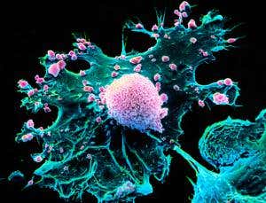 Breast cancer impersonates neurons to invade the brain