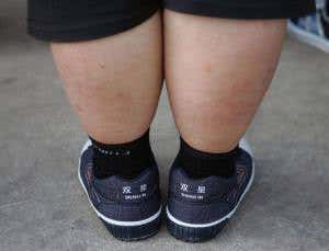 Obesity epidemic becomes worldwide phenomenon