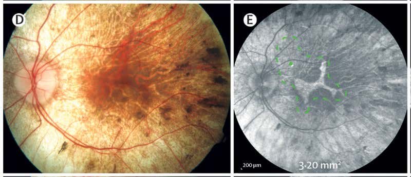 A section of the retina, marked by green dots, was detatched ready for gene therapy injection