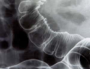 Healing by faeces: Rise of the DIY gut-bug swap