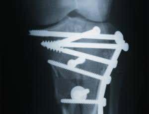 Silk screws are strong enough to mend broken bones