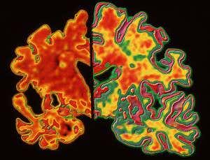 First test to predict Alzheimer's years in advance