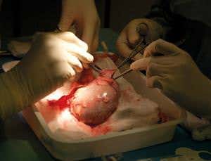 Reboot the immune system to avoid transplant rejection