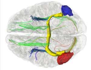 Separated at birth, but split brains build new bridges