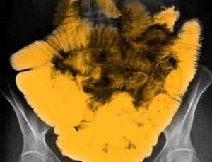 Fixing leaks in the gut may stall progression of HIV