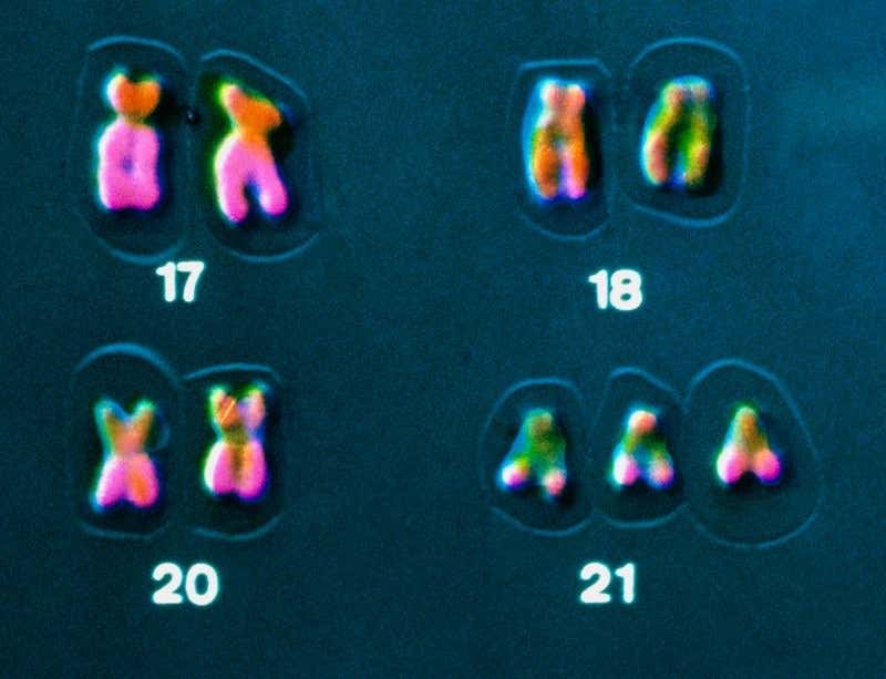 Down's syndrome is caused by having an extra copy of chromosome 21