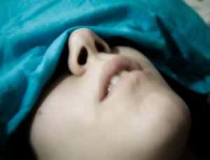 Stem cell treatment causes nasal growth in woman's back