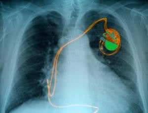 Biological pacemaker keeps a beat without the hardware