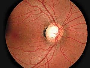 Eye implant turns smartphone into a glaucoma monitor