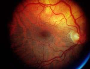 Stem cells used in landmark therapy for failing sight