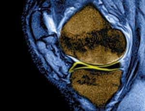 Wrecked knees? Nose cartilage can fix them
