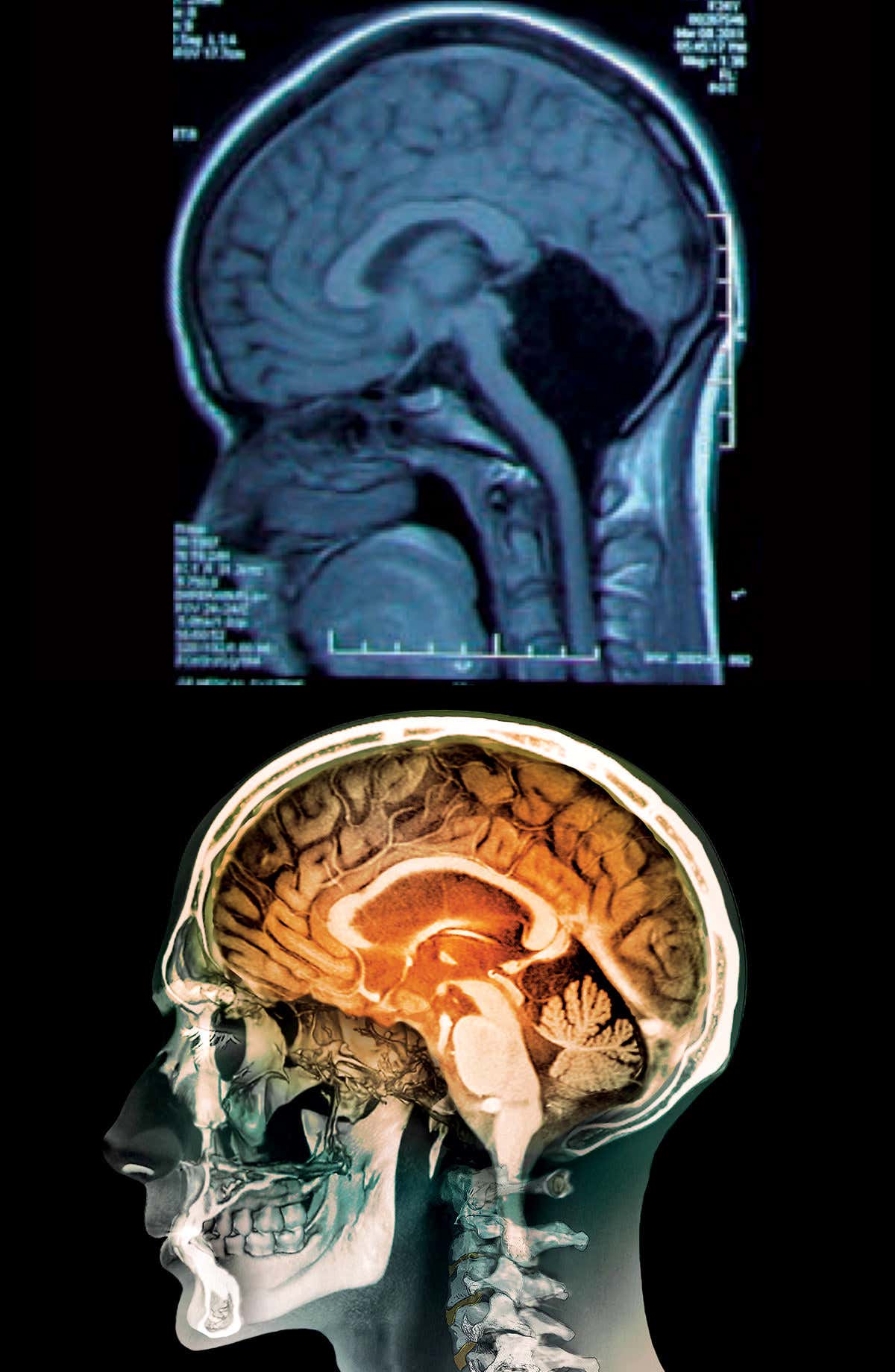 Two brain scans, one with a hole where the cerebellum should be