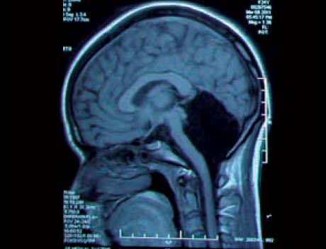 Scan of a person's brain showing a hole where the cerebellum should be
