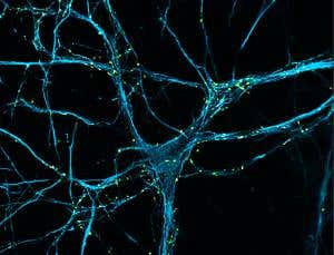 Killer in the brain could help treat Parkinson's