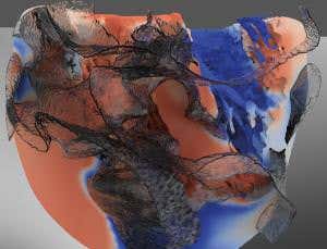 Watson supercomputer looks for genetic heart danger