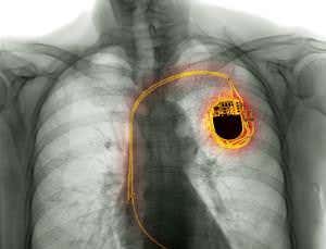 Murder by hackable implants no longer a perfect crime