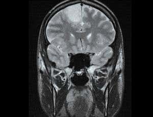 Radical therapies that could beat my brain tumour