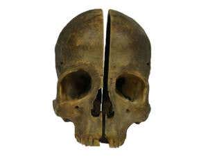 Split skull provides rare slice of dissection history