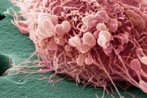 Heart drug reduces risk of cancer spreading