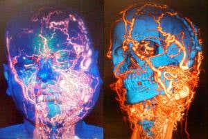 Face transplant fixes dangerous knot of blood vessels