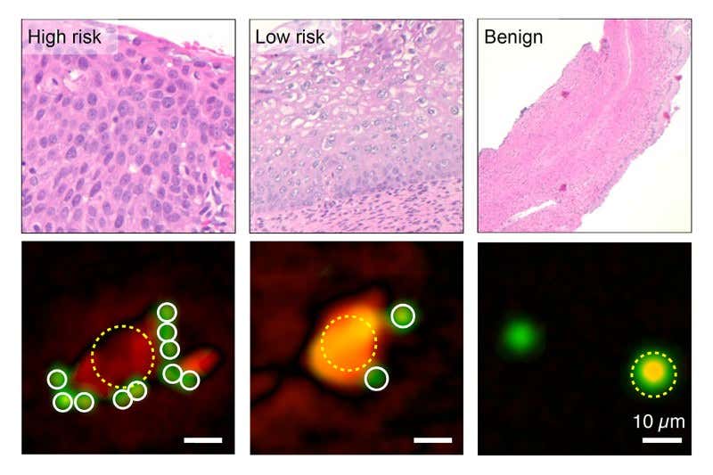 Smartphone holograms can diagnose cervical cancer