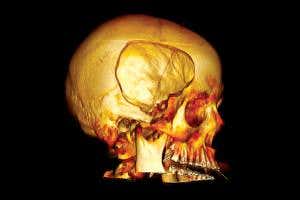 Is a hole in the head the answer to traumatic brain injury?