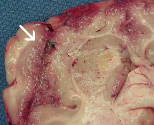 Brain-eating amoebas kill by turning your body against you