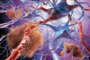 Iron levels in brain predict when people will get Alzheimer's