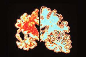 Alzheimer's may have been transmitted via human growth hormone