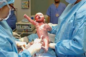 Do babies born at the weekend have higher risk of complications?