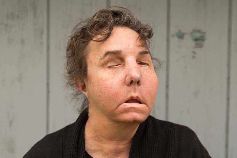 What living with a face transplant has taught me about myself