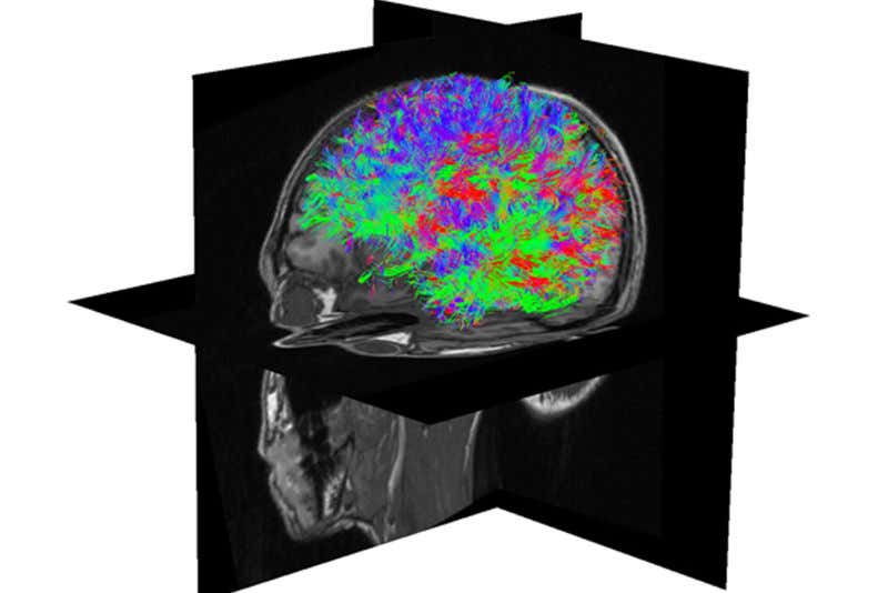 Virtual brain surgery could personalise epilepsy treatment