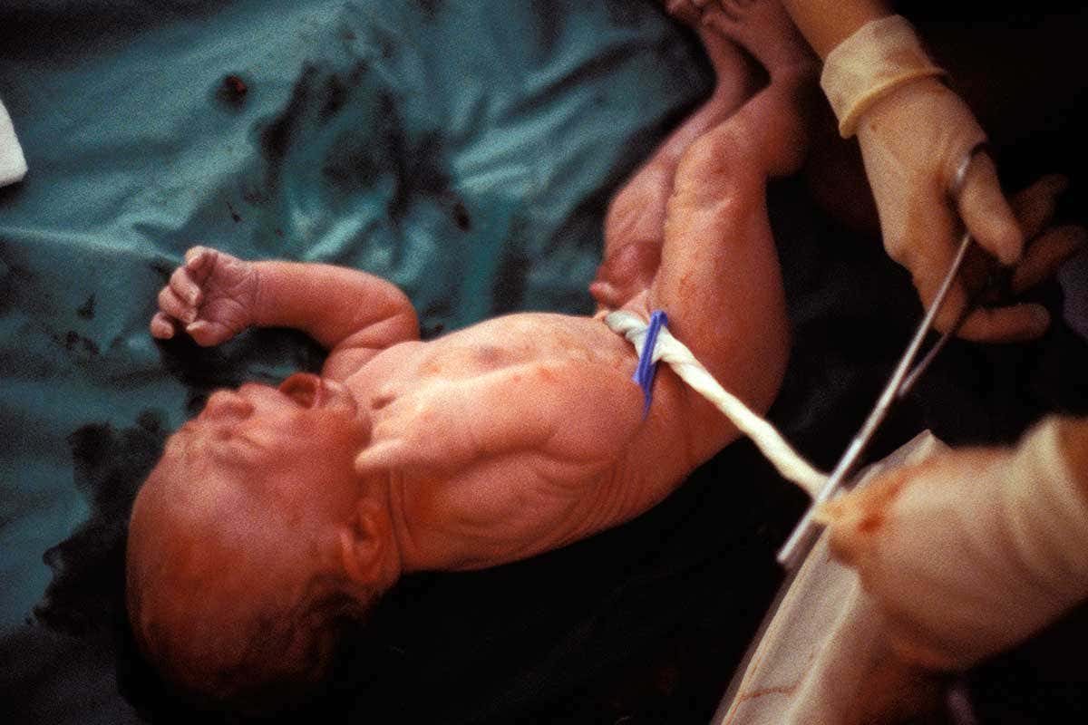 A baby having its umbilical cord cut