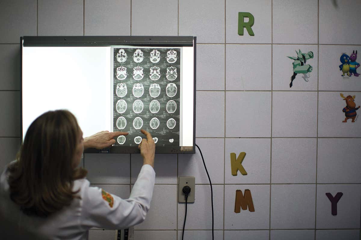 Microcephaly brain scans
