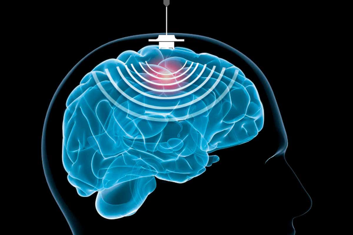 A diagram showing ultrasound being delivered to the brain as part of the new technique
